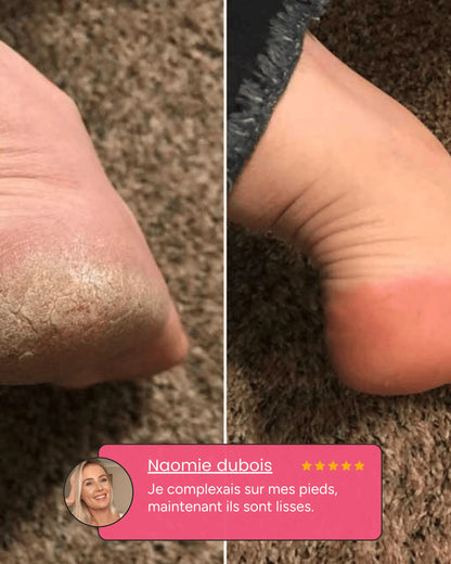 Snipido Glow Pro 3| Anti-callosités